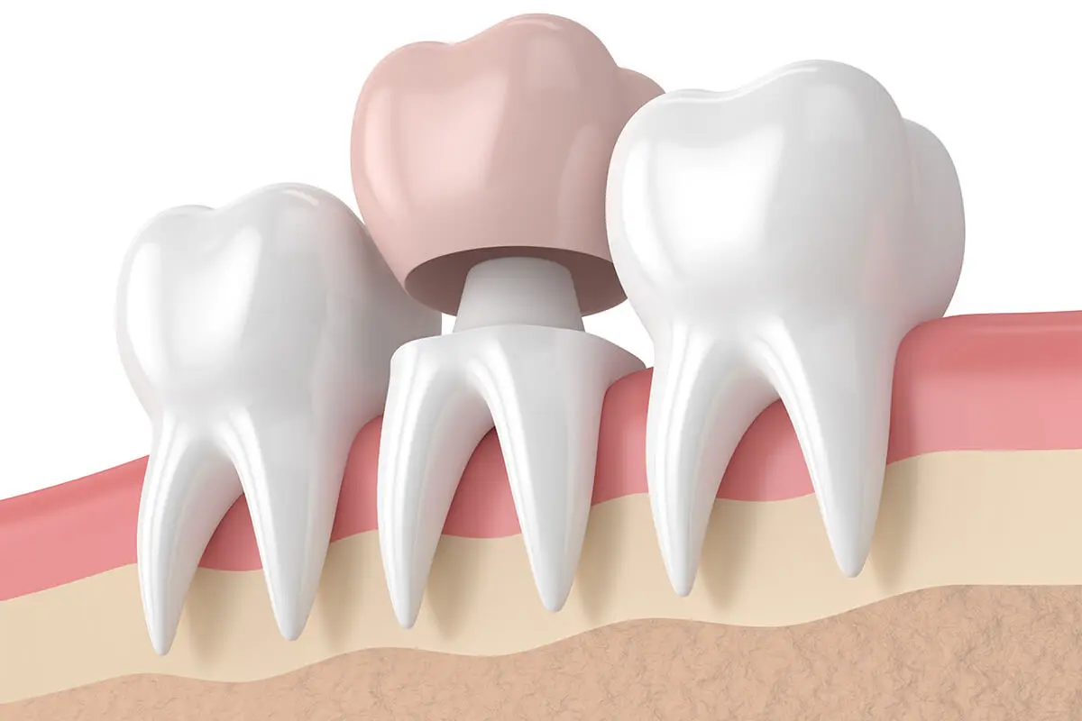 Dental Crown Placement