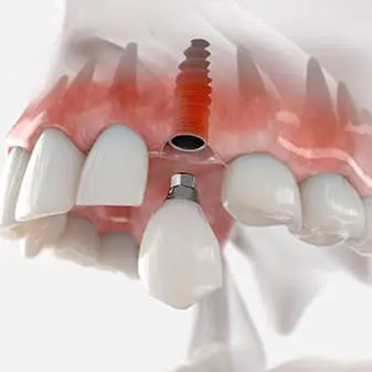 Guided Implant Surgery