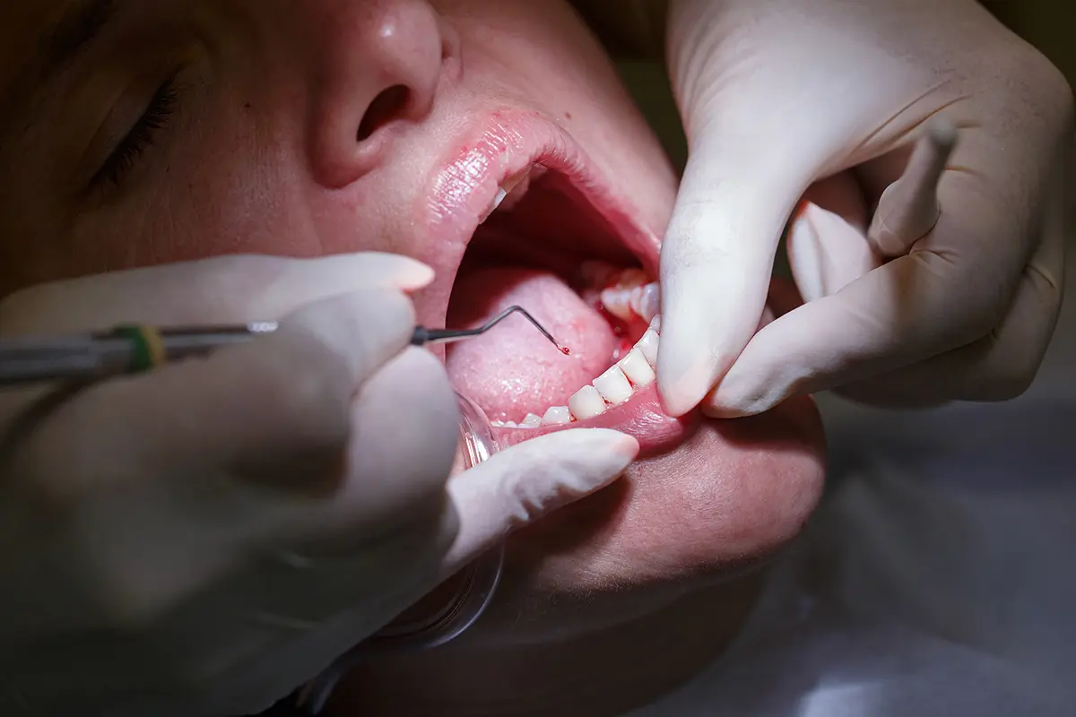 Early Signs of Periodontal Disease You Should Never Ignore