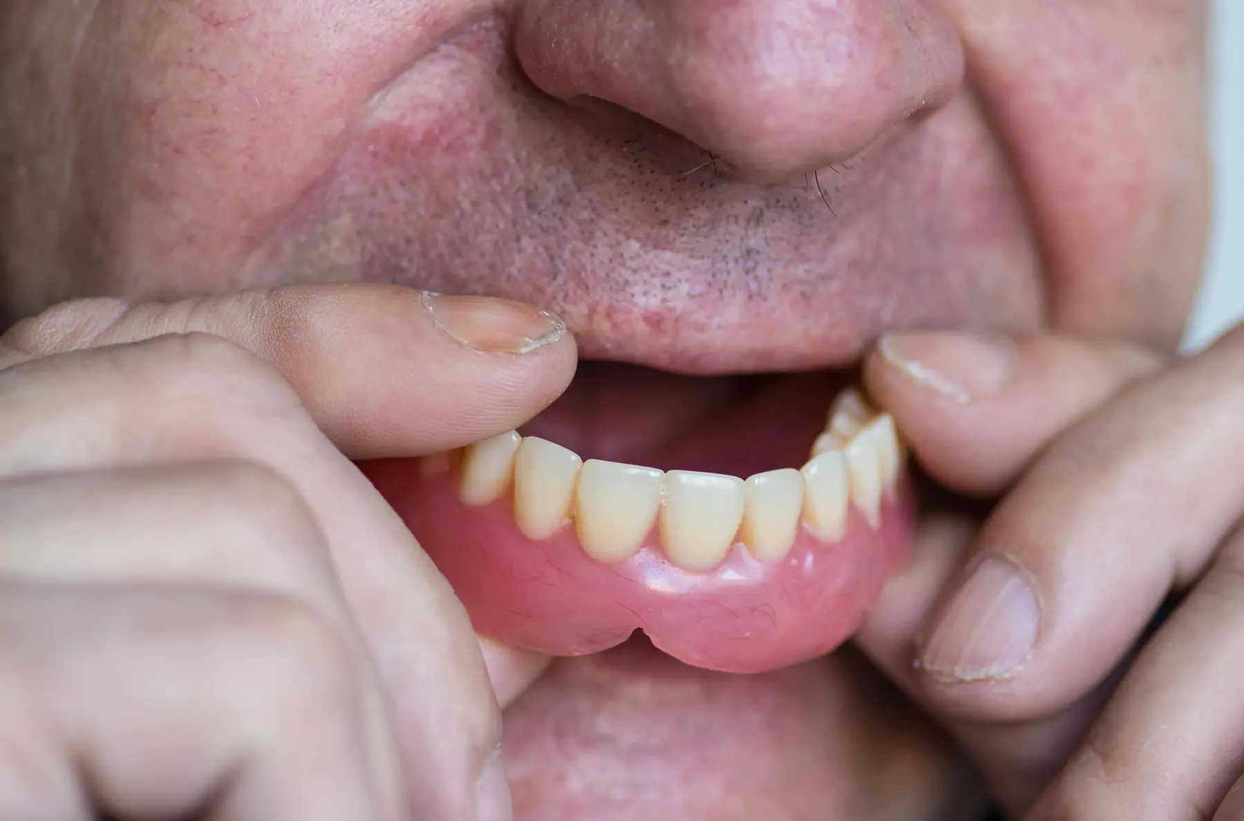 Why Dentures Feel Loose Over Time and What Can Be Done