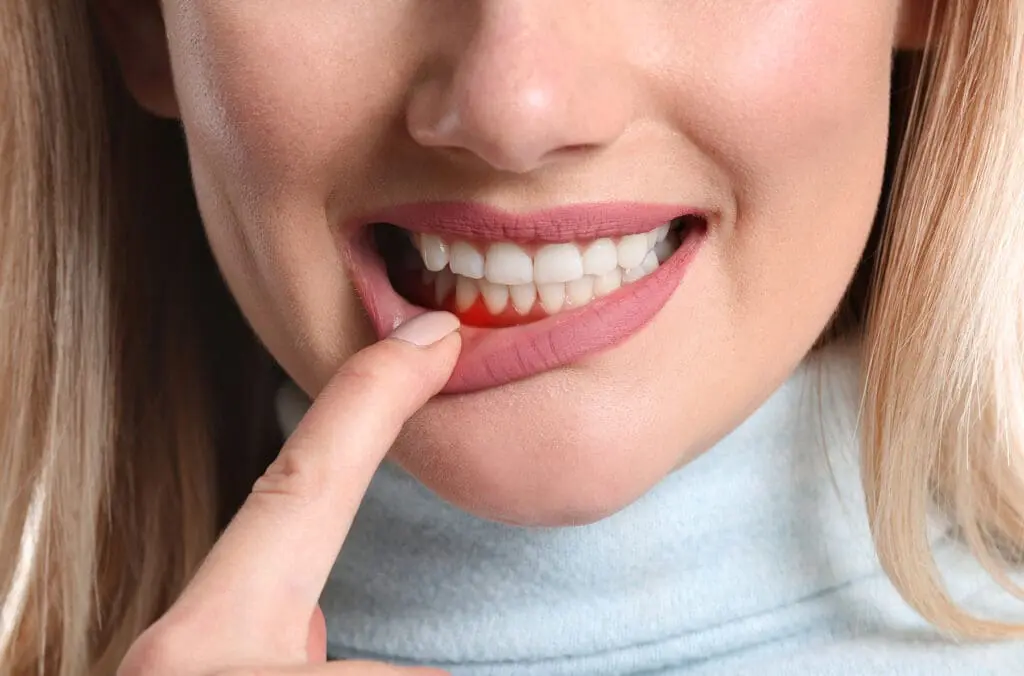 Veneers and Gum Disease: Timing and Treatment