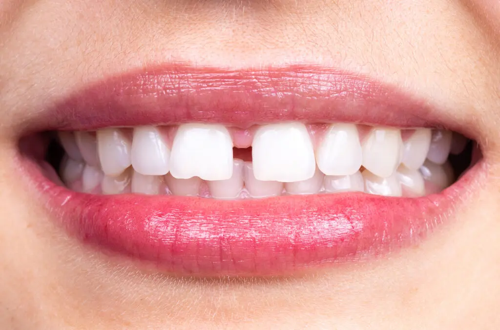 Chipped Tooth Repair: Treatment Options