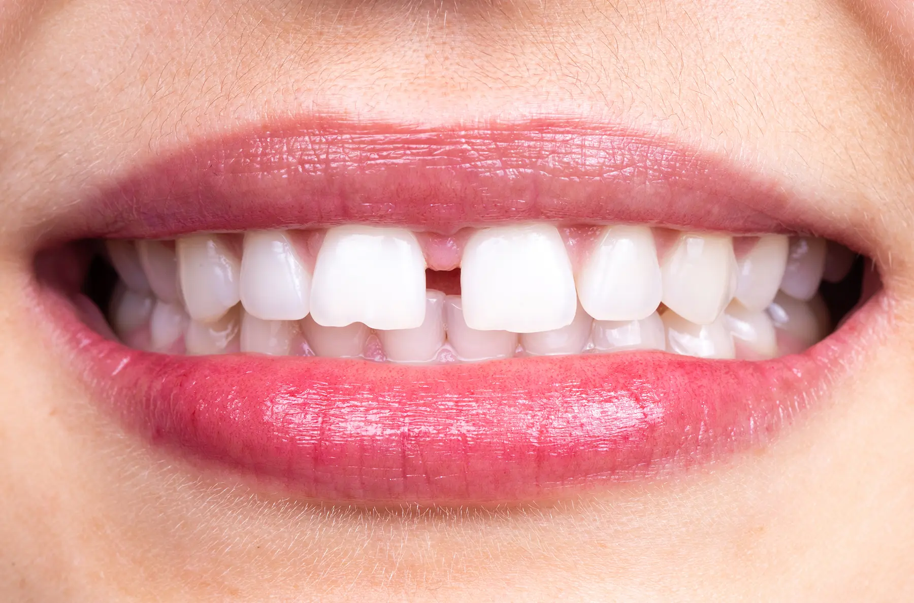 Chipped Tooth Repair: Treatment Options