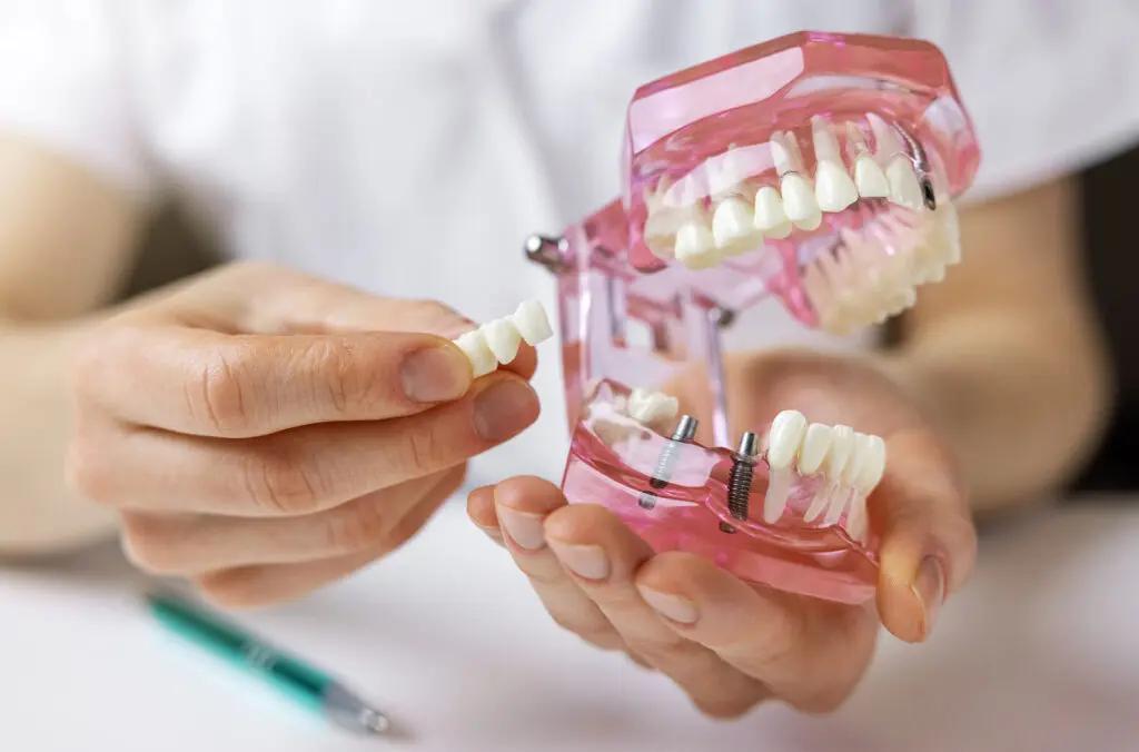 Dental Bridge vs Implant: Comparing Both Options