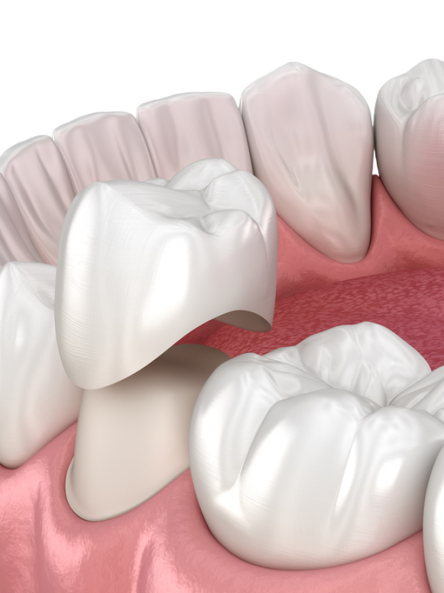 Benefits of Dental Crowns