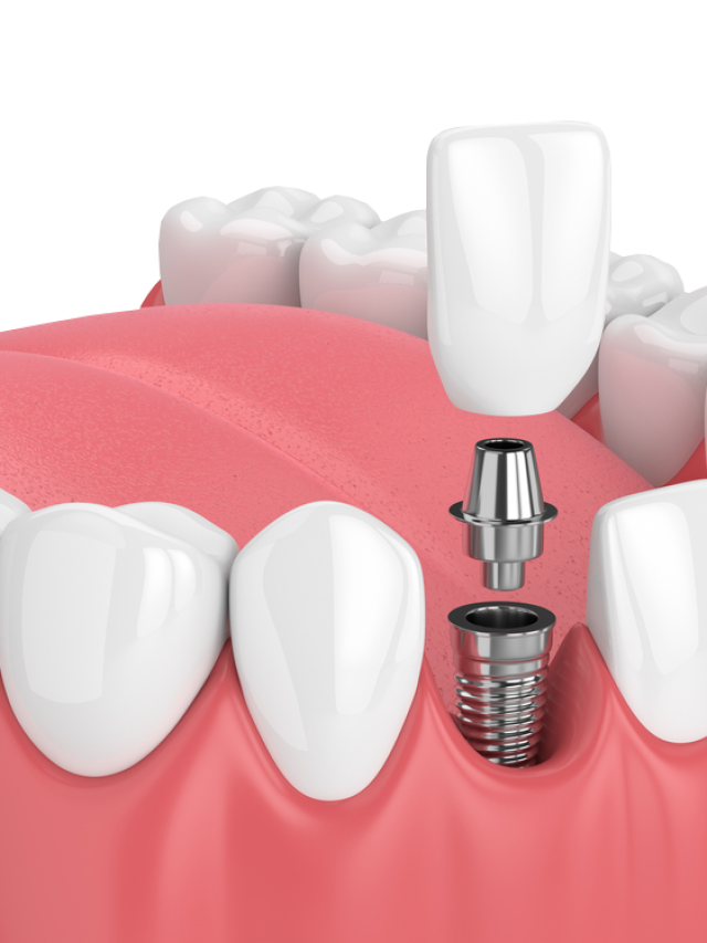 Some benefits you can enjoy with dental implants
