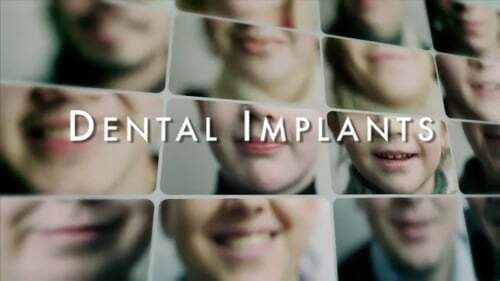 Dental implants