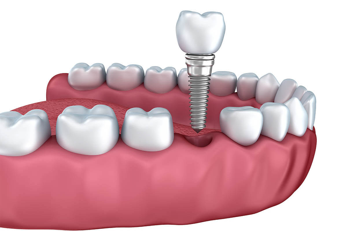 Bone Graft for Dental Implants in Centennial CO Area