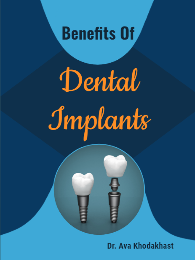 Benefits of Dental Implants