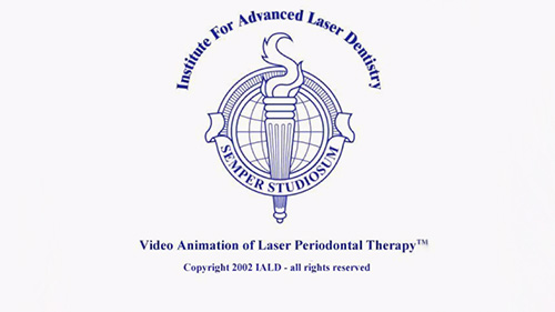 Video Animation of Laser Periodontal Therapy