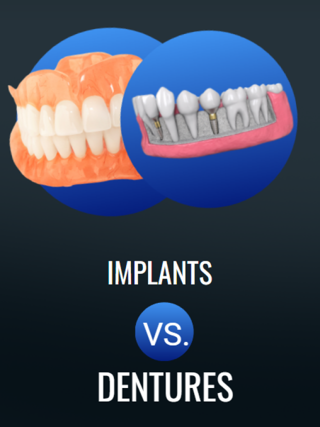 Implants vs. Dentures