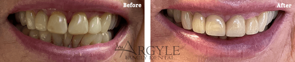 Full Mouth Rehabilitation Before and After Actual patient result image at Argyle Family Dental, CO, Case - 4