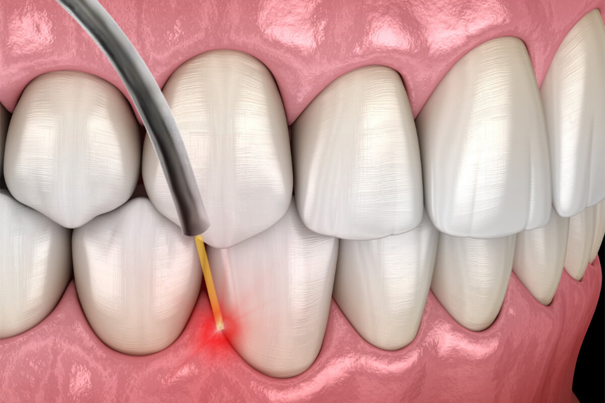 Laser Assisted Periodontal Treatment in Centennial CO Area